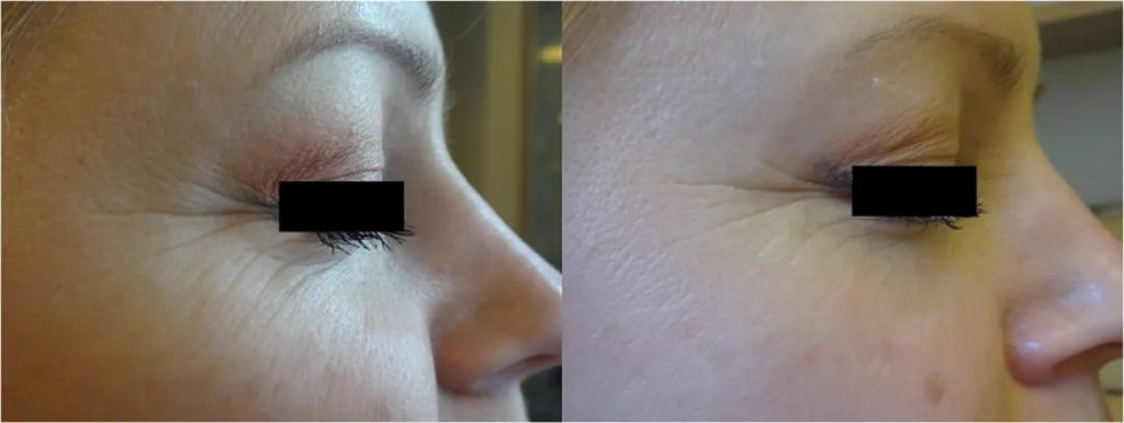 Before and after IPL treatment of periocular wrinkles