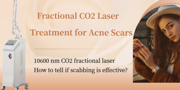 CO2 Fractional laser machine best laser treatment for acne scars