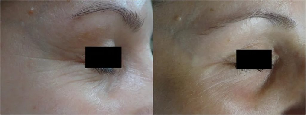 Comparison before and after 1927nm non-ablative fractional thulium laser treatment for wrinkles around the eyes