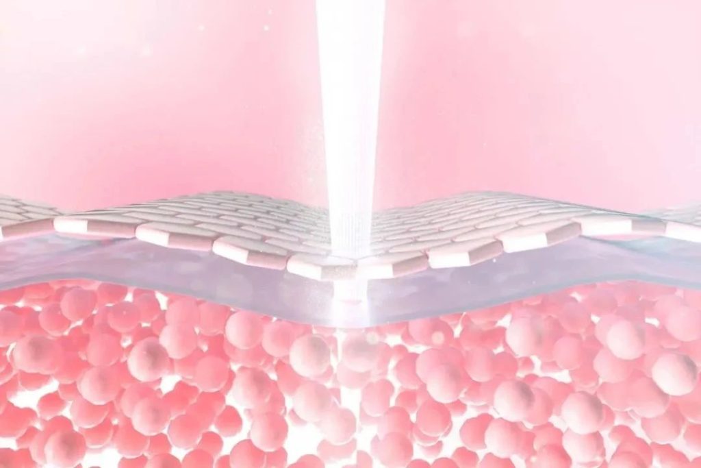 Fractional CO2 laser energy beam enters the skin