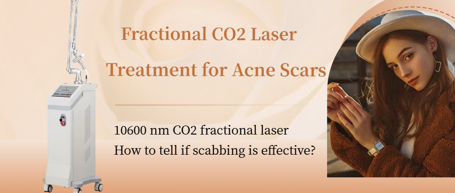 Fractional CO2 laser machine best laser treatment for acne scars