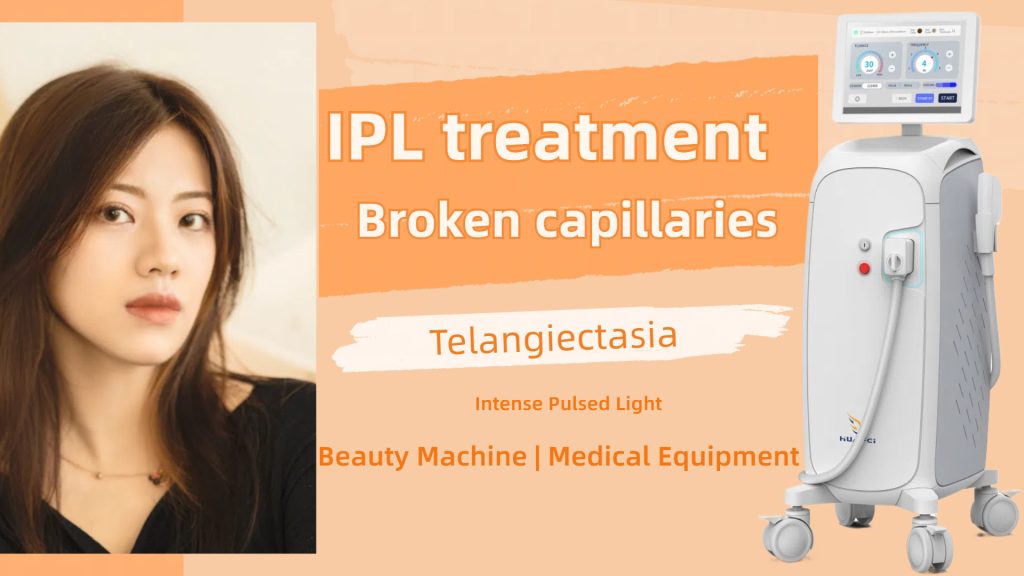 IPL treatment for broken capillaries and intense pulsed light to reduce telangiectasia