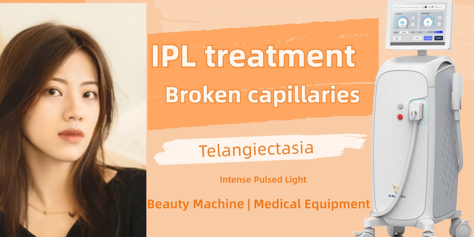 Intense Pulsed Light to reduce telangiectasia and IPL treatment for broken capillaries