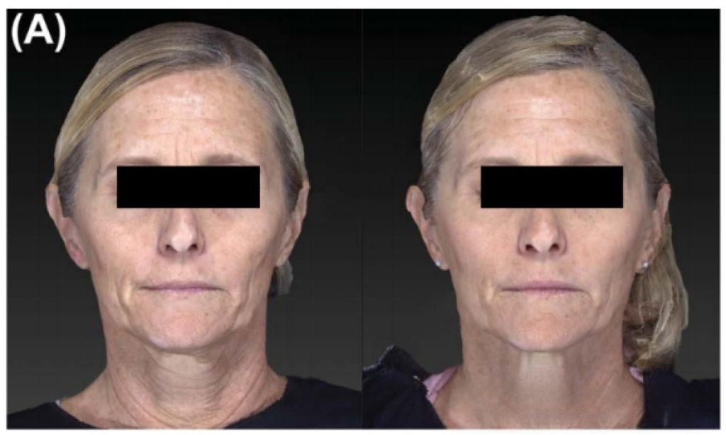 Monopolar radiofrequency machine anti-aging before and after comparison chart