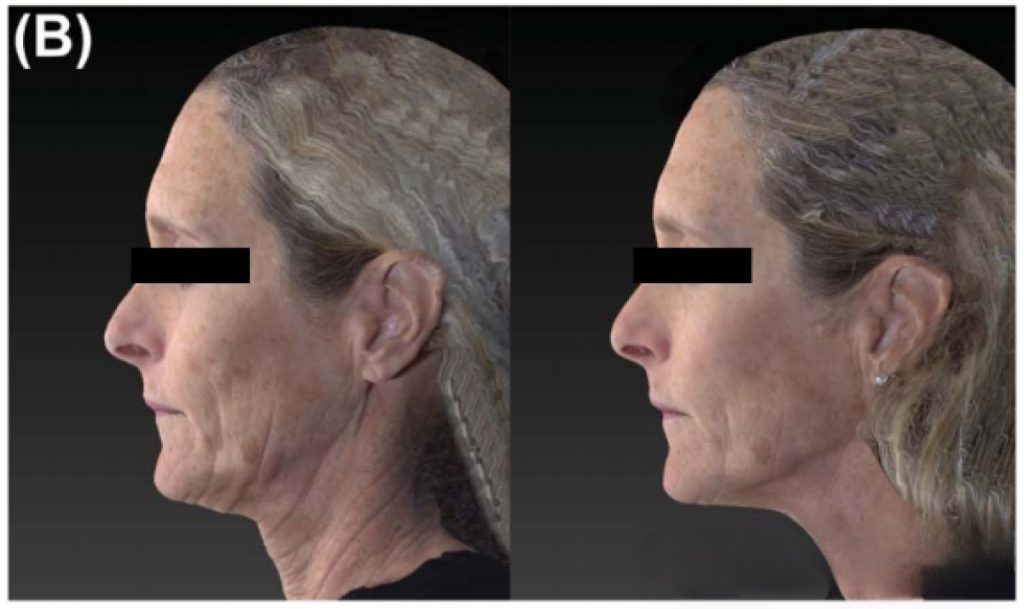 Monopolar radiofrequency machine skin tightening before and after comparison