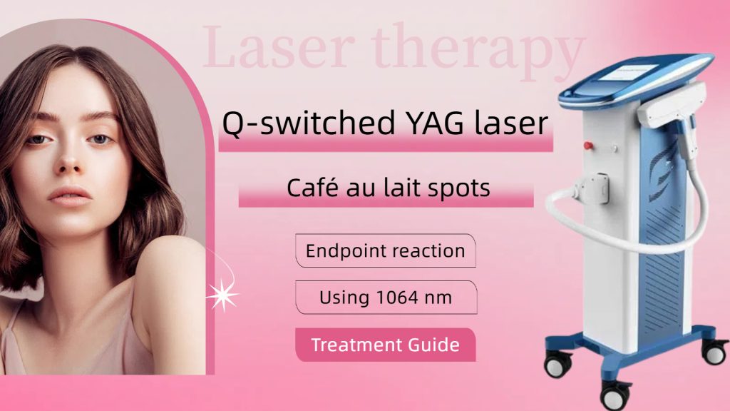 Q-switched ND YAG laser treatment for Café au lait spots