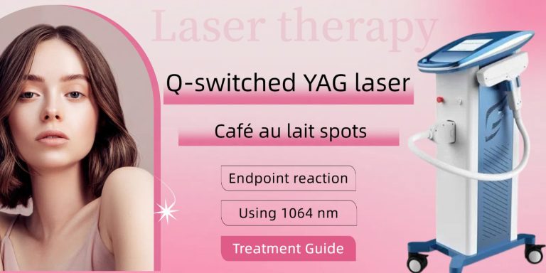 Q-switched ND YAG laser treatment of Café au lait spots