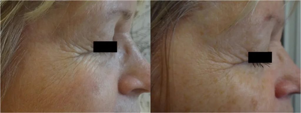 Radiofrequency treatment for wrinkles around the eyes before and after