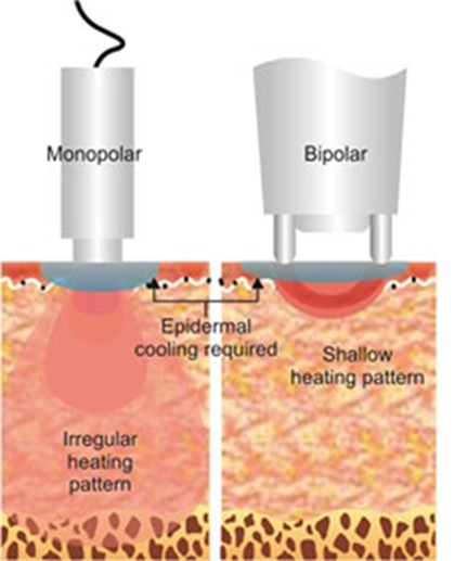 The difference between monopolar radiofrequency and bipolar radiofrequency