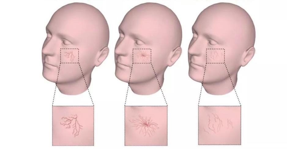 Three common types of facial telangiectasia