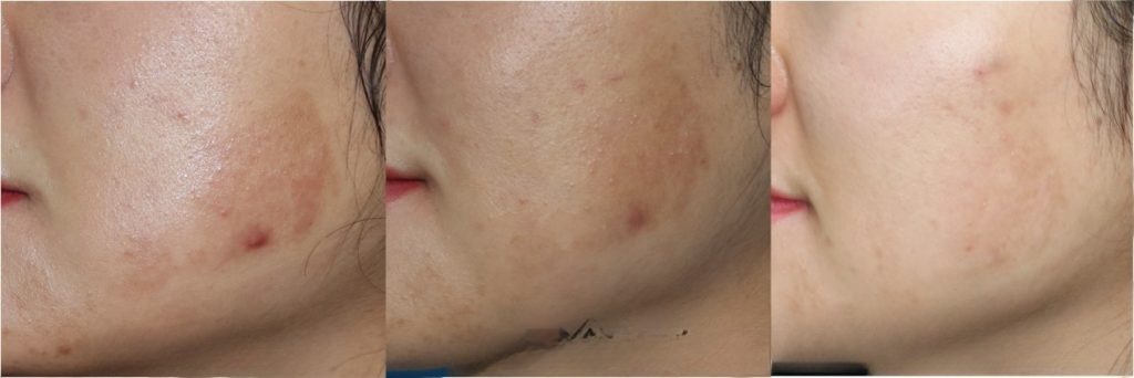 Before and after comparison of IPL machine treatment of inflammatory pigmentation