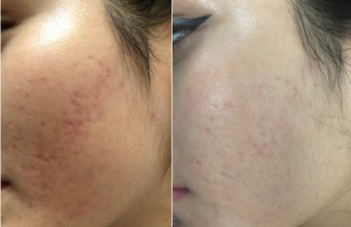 Comparison before and after pictures of IPL machine treating post-acne erythema