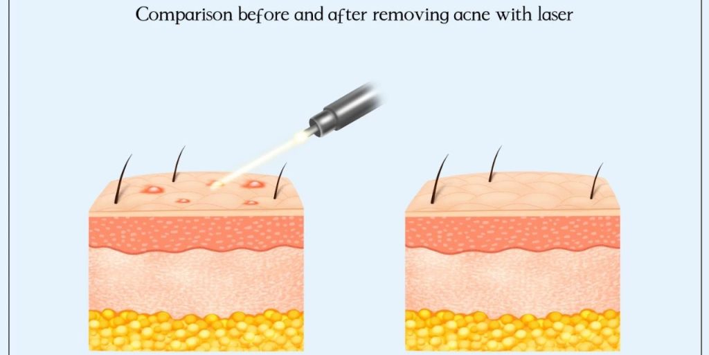 Laser acne treatment principle diagram