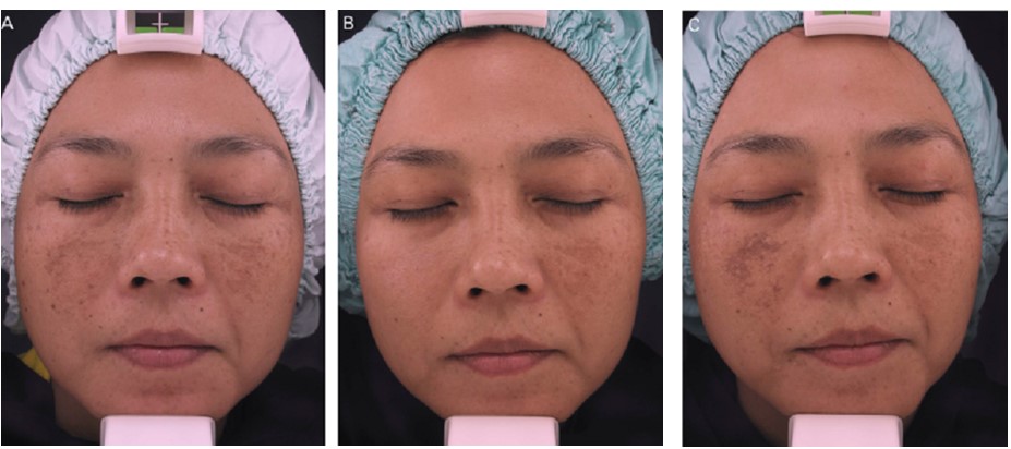 Laser treatment for melasma before and after pictures