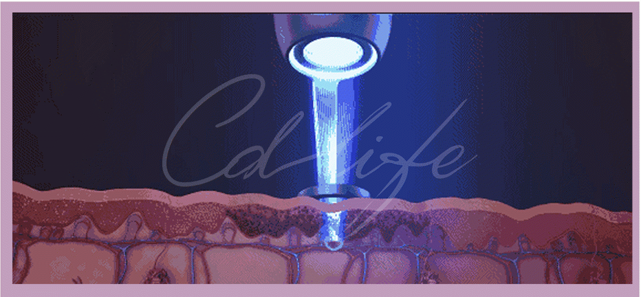 Skin changes after pico laser treatment for melasma