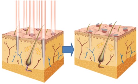 1550 nm erbium laser beam enters the skin