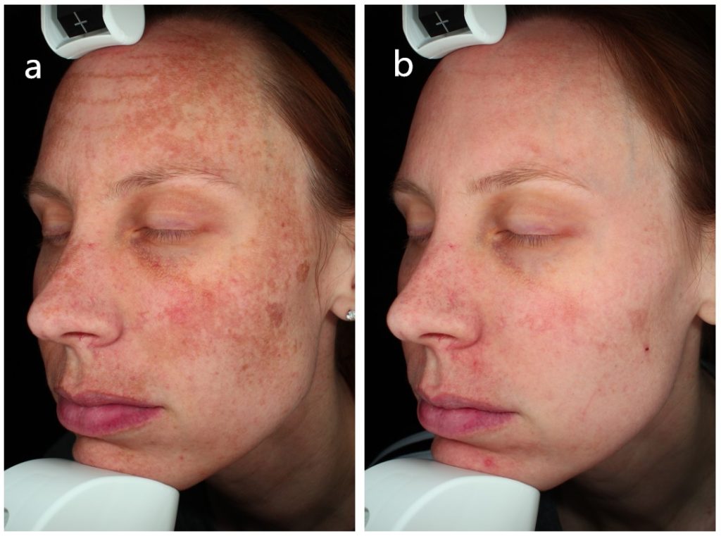 1550nm and 1927nm dual wavelength laser treatment of melasma before and after