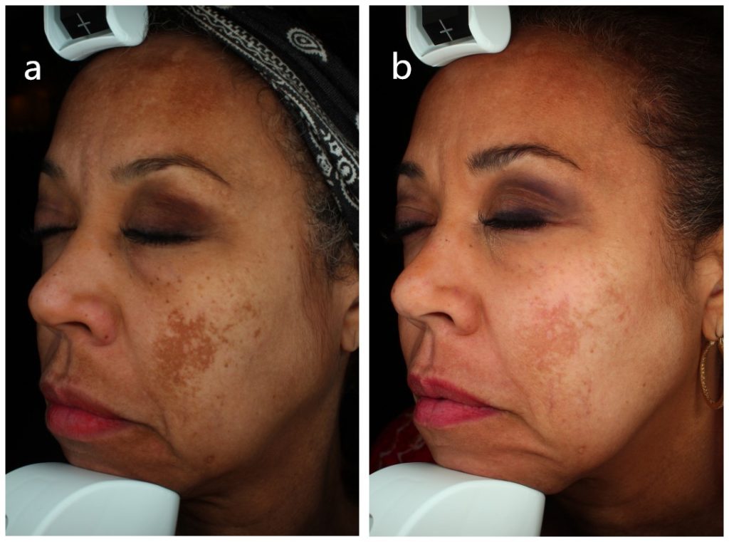 1550nm and 1927nm dual wavelength laser treatment of melasma before and after one month