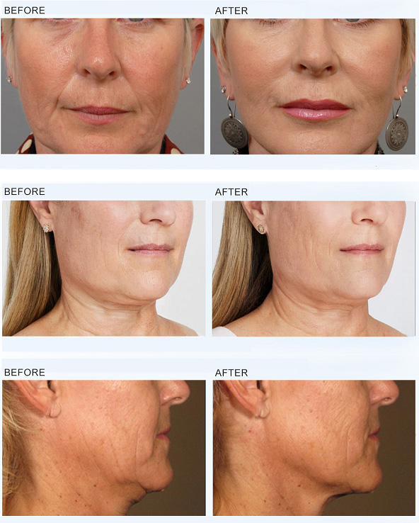 EMFACE treatment before and after pictures