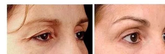 Thermage before and after treatment for the eye area