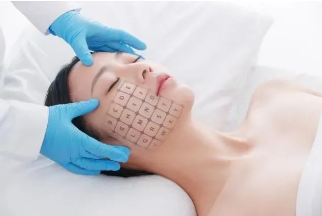 Thermage treatment for facial anti-aging