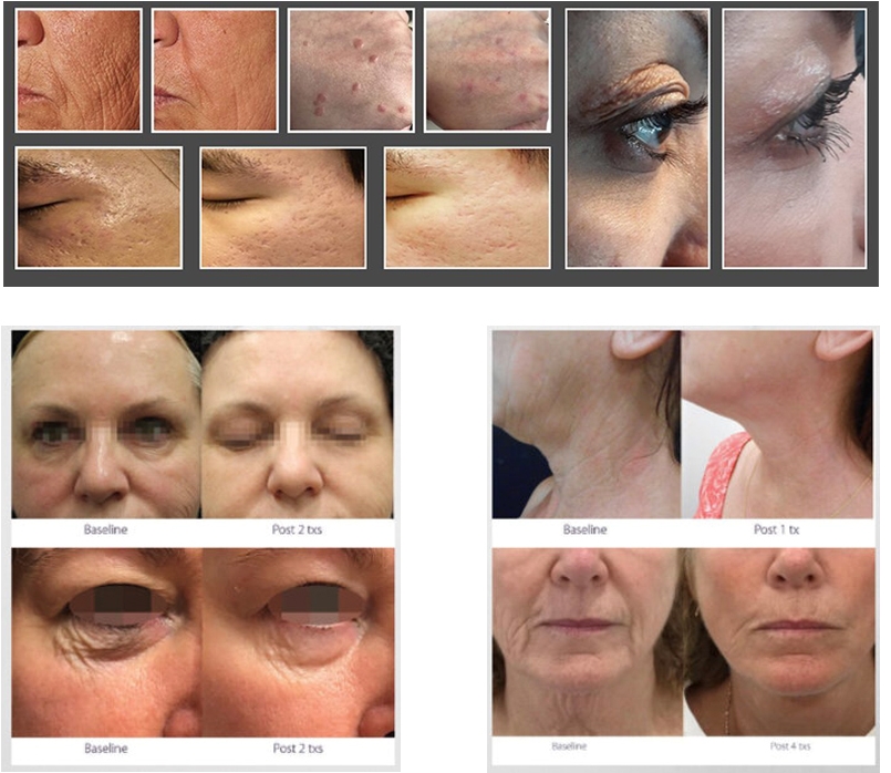 fractional plasma 3 in 1 machine treatment before and after