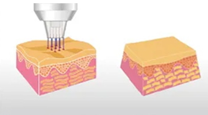 plasma fractional handle working principle