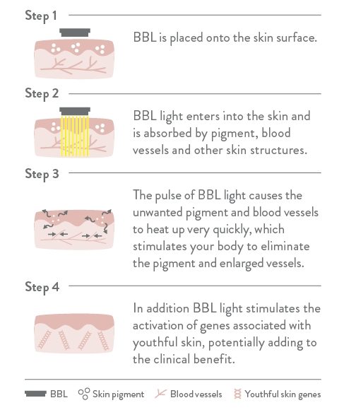 BBL Photorejuvenation Skin Treatment