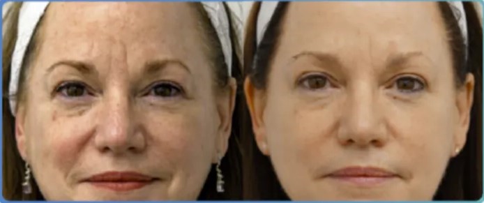 BBL laser anti-aging before and after