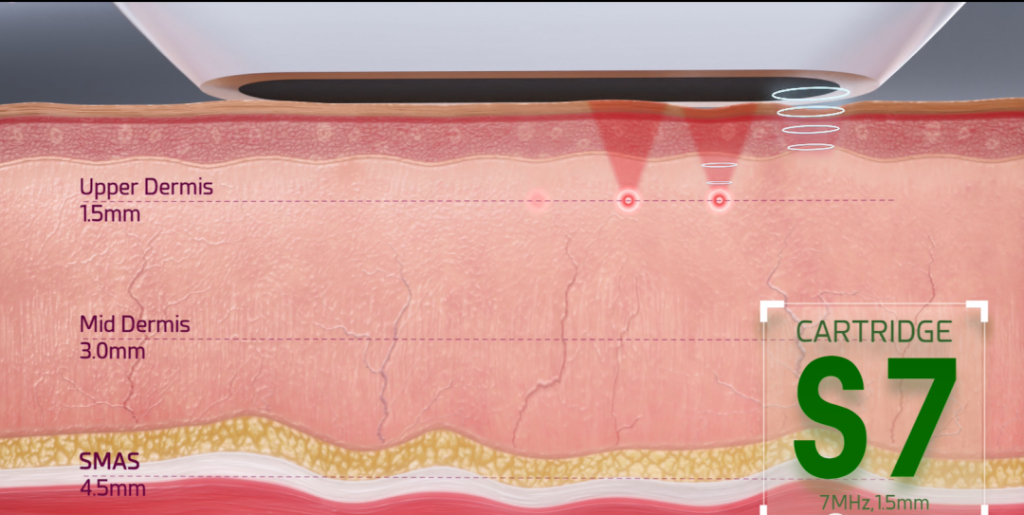 HIFU machine subcutaneous 1.5mm depth treatment