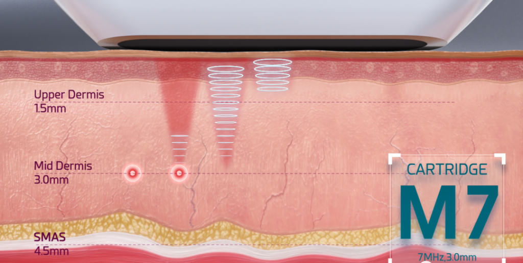 HIFU machine subcutaneous 3.0mm depth treatment