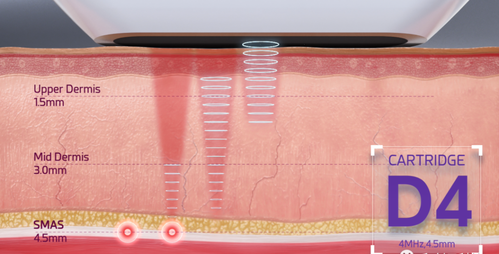 HIFU machine subcutaneous 4.5mm depth treatment