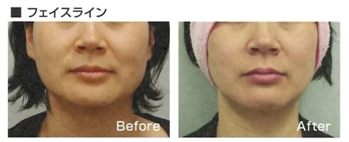 HIFU skin tightening treatment before and after