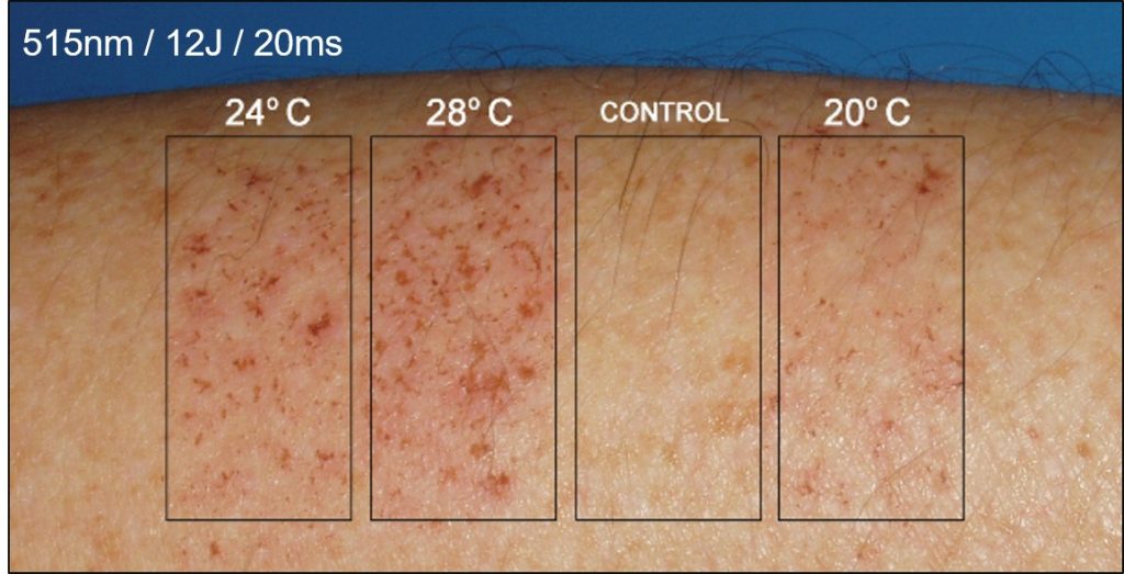 Thermal damage caused by different temperatures on the human epidermis.