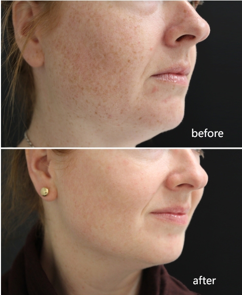 bbl laser before and after 1 treatment