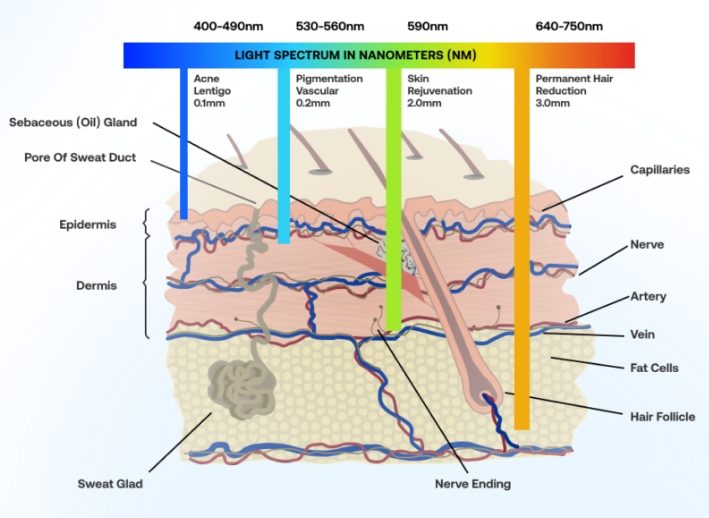 bbl laser treatment