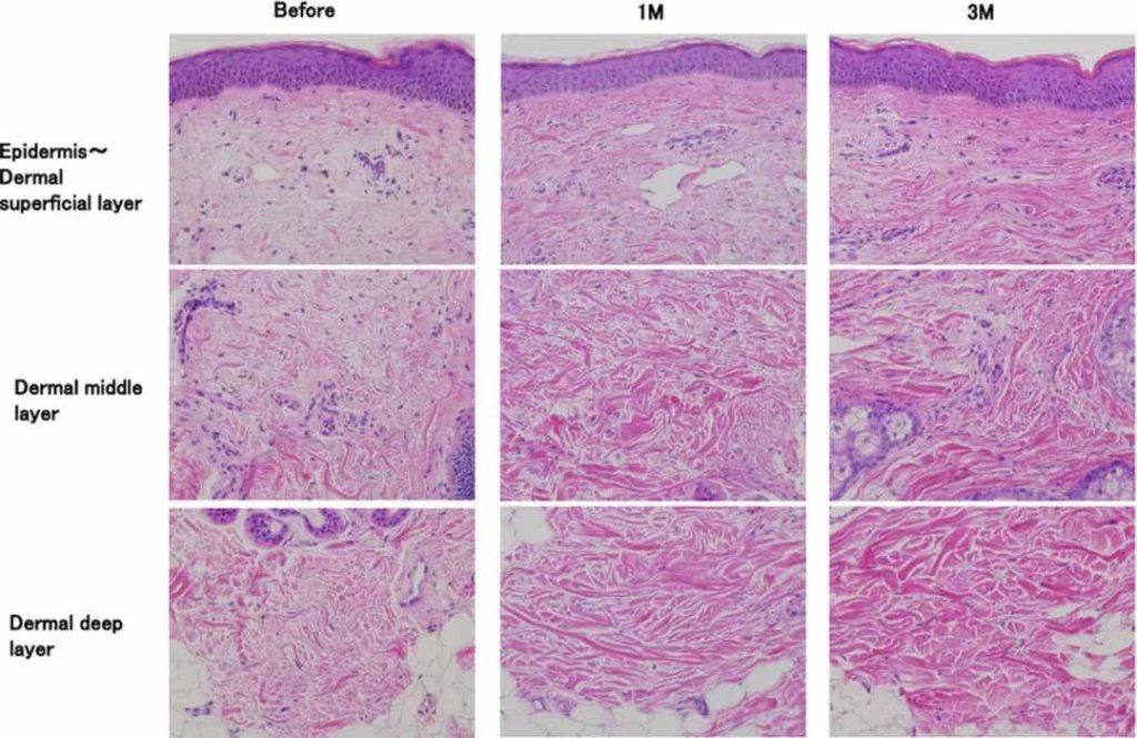 Changes in skin collagen fibers before and after Thermage treatment