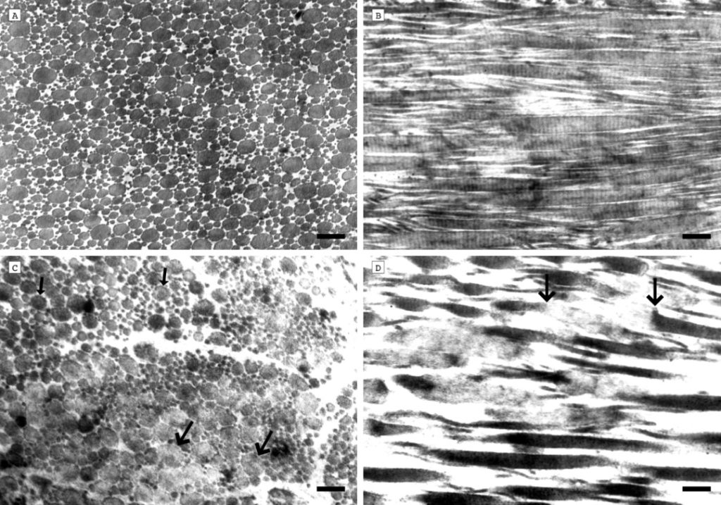 Changes of collagen fibrils in pathological sections before and after RF treatment