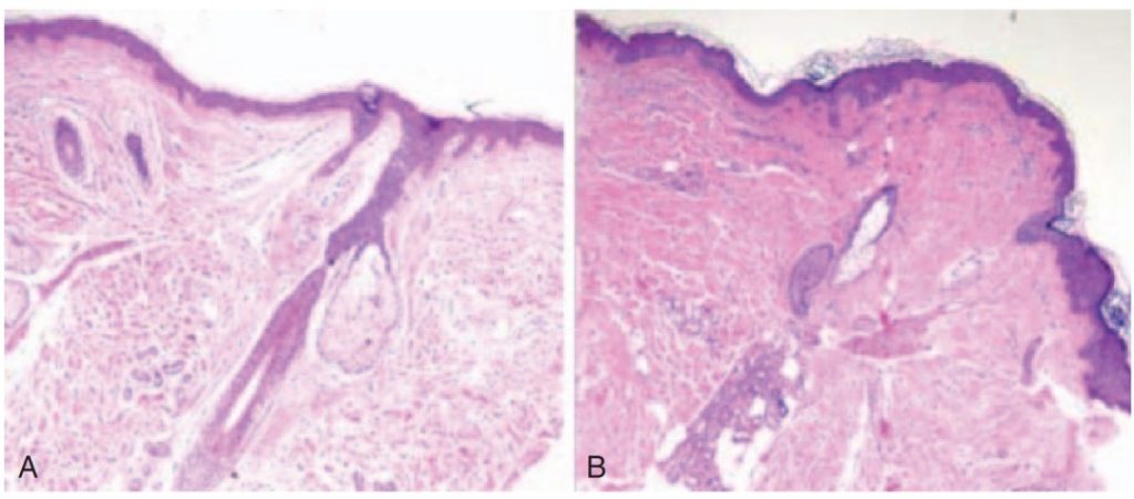 Collagen changes in pathological sections after Thermage treatment