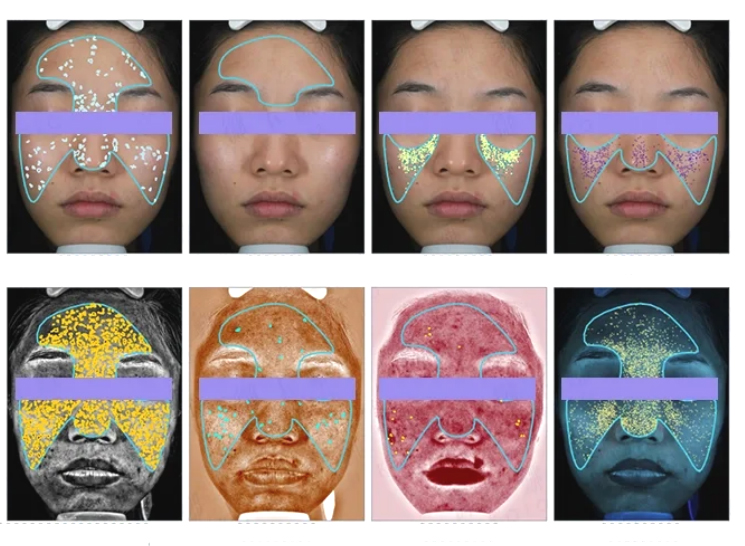 Eight skin parameters of the VISIA Skin Analyzer