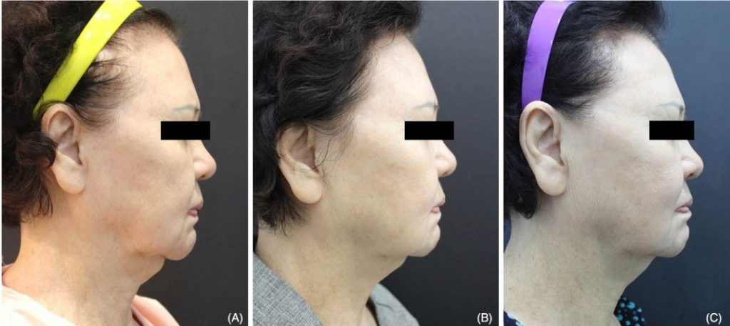 Skin tightening comparison before and after monopolar RF treatment