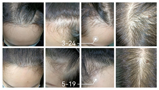 1927nm thulium laser treatment for hair regrow