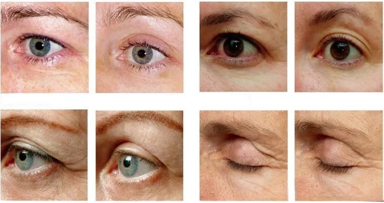 4 clients before and after Thermage skin tightening treatment