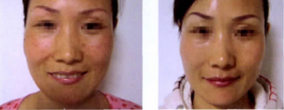 Before and after 5 times of IPL treatment for freckles