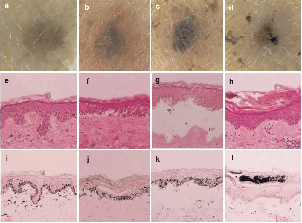 Skin microscopy pictures before and after IPL freckle removal