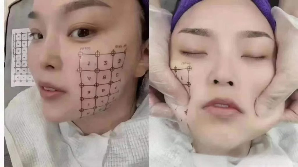 Thermage facial skin lift before and after