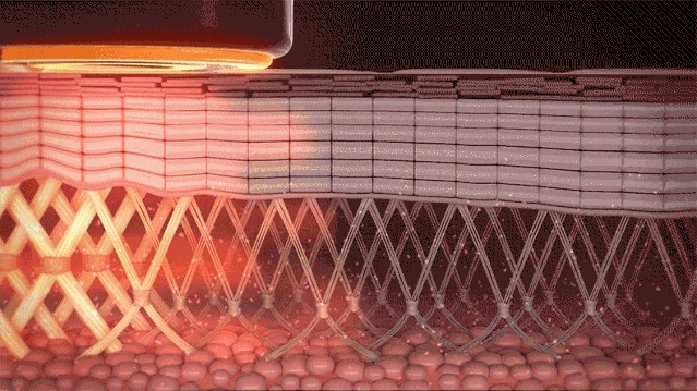 Thermage treatment principle diagram